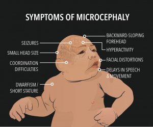 MICROCEPHALY